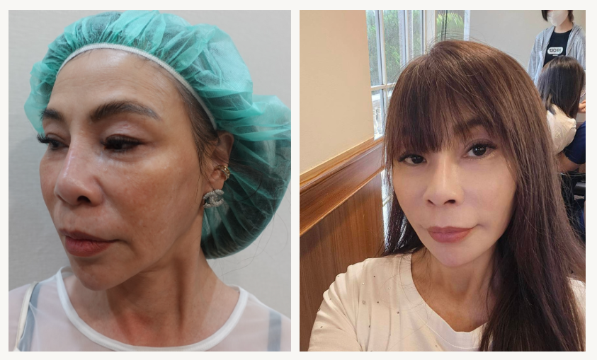 下垂型法令紋埋線拉提案例:埋線前後的臉部對比照