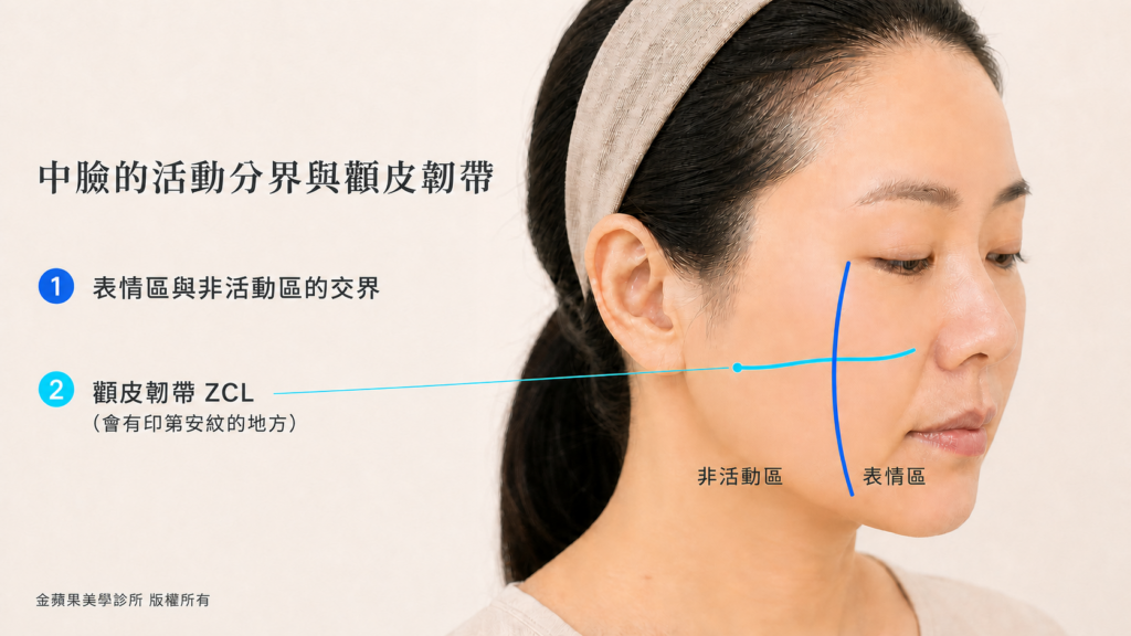 無痕筋膜拉提改善木偶紋與嘴邊肉：嘴角旁三條肌肉與布線位置示意圖