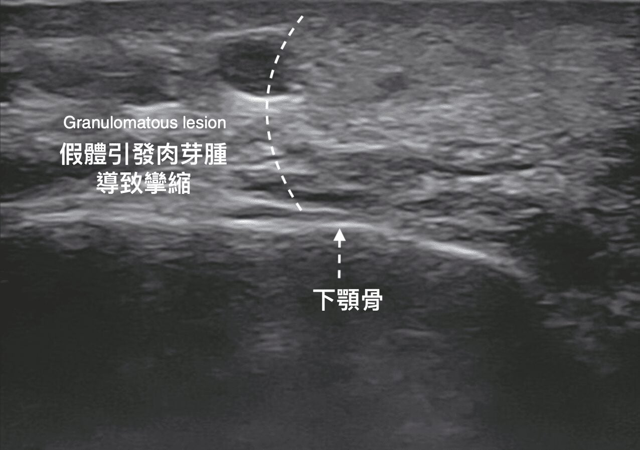 超音波影像：下巴假體引發肉芽腫導致攣縮，並標示下顎骨位置