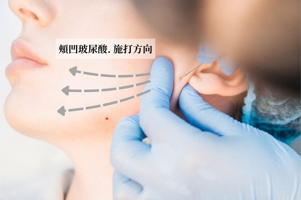 臉頰凹陷玻尿酸施打方向示意：由耳屏前進針，鈍針往前呈扇形填補