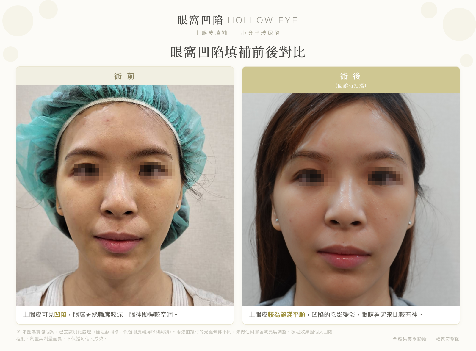 眼窩凹陷填補前後對比：術前上眼皮凹陷、眼窩骨緣輪廓較深；術後上眼皮較飽滿平順，凹陷陰影變淡