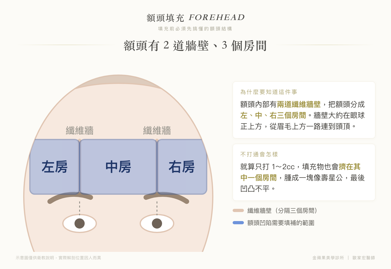 額頭填充解剖示意圖：額頭內部兩道纖維牆壁把額頭分成左房、中房、右房三個房間，牆壁位於眼球正上方