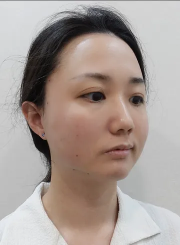 神力拉提埋線術後恢復期實照：下顎輪廓線條緊緻、無明顯腫脹瘀青
