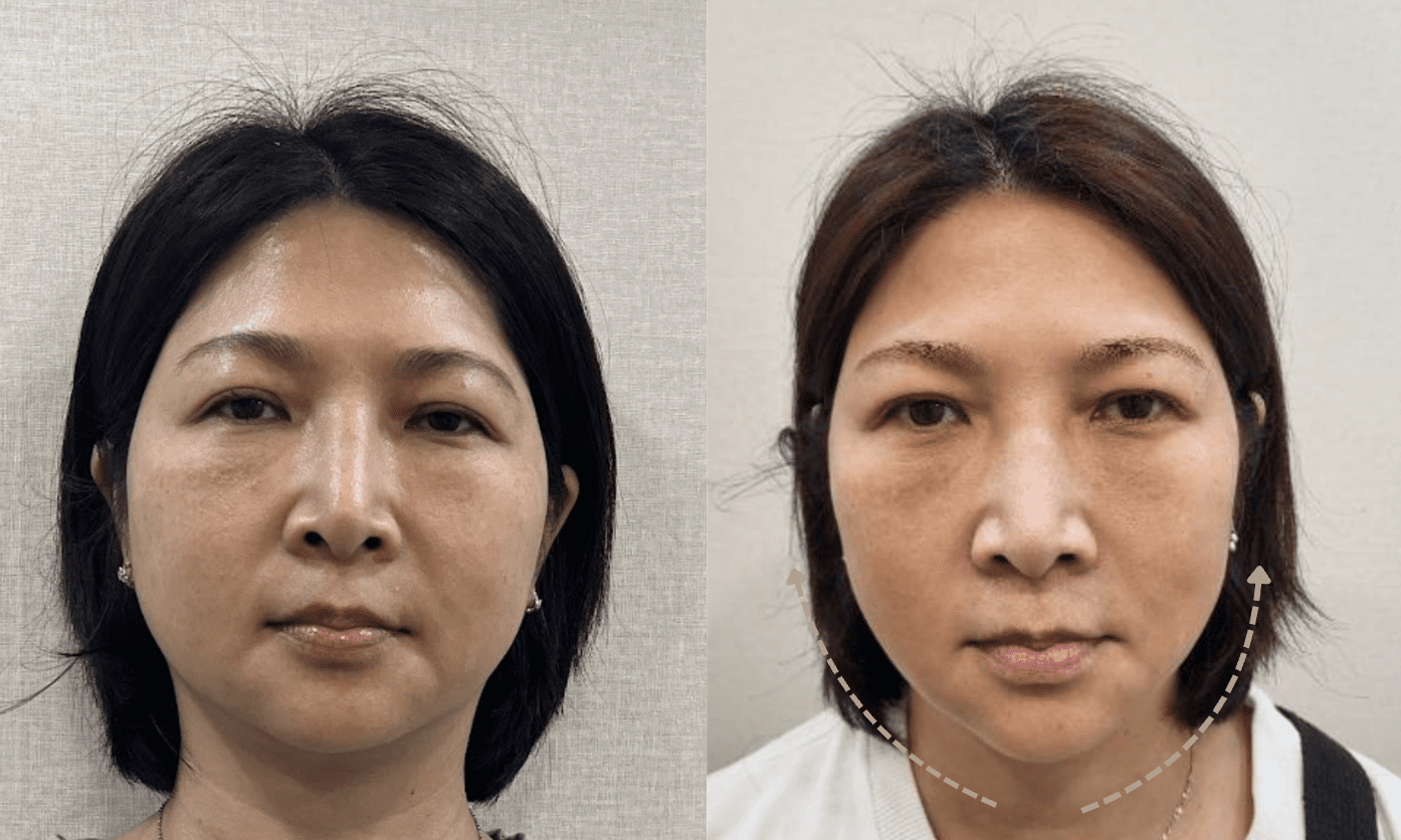 金蘋果美學診所案例 1：改善法令紋＆木偶紋