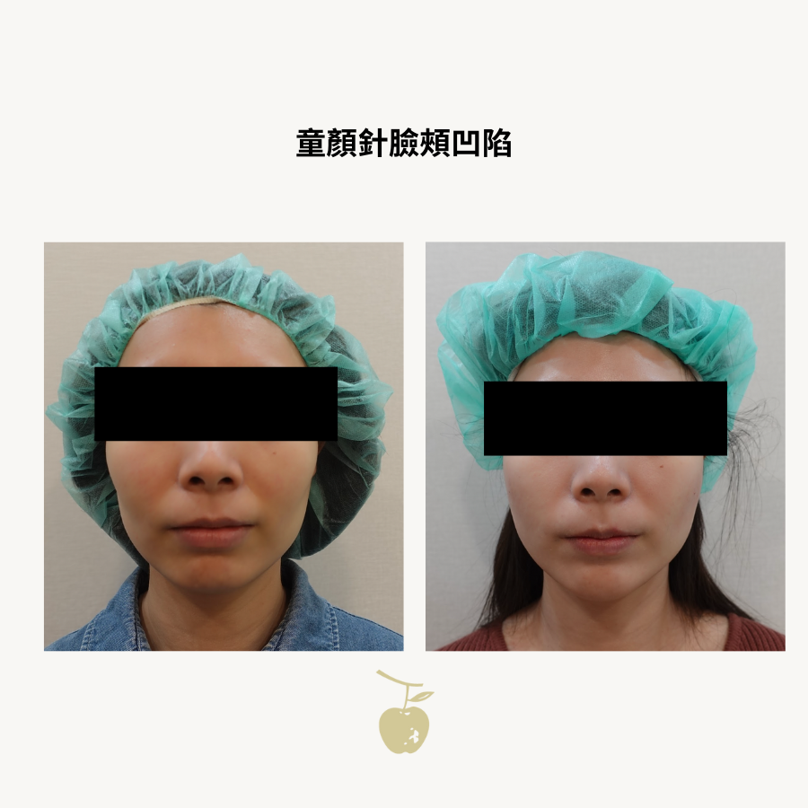 童顏針臉頰凹陷一瓶施打四個月後正面對照