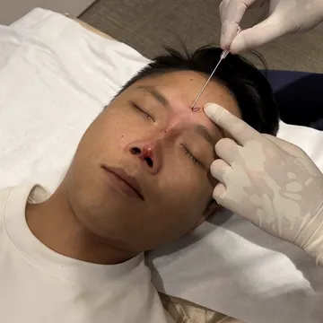 醫師於客人山根處進行埋線鼻雕短線置放的操作照