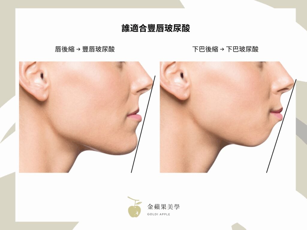 誰適合豐唇玻尿酸示意圖：唇後縮與下巴後縮的側臉比較