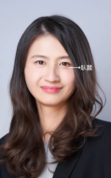 女性正面照，箭頭標示眼下臥蠶的位置