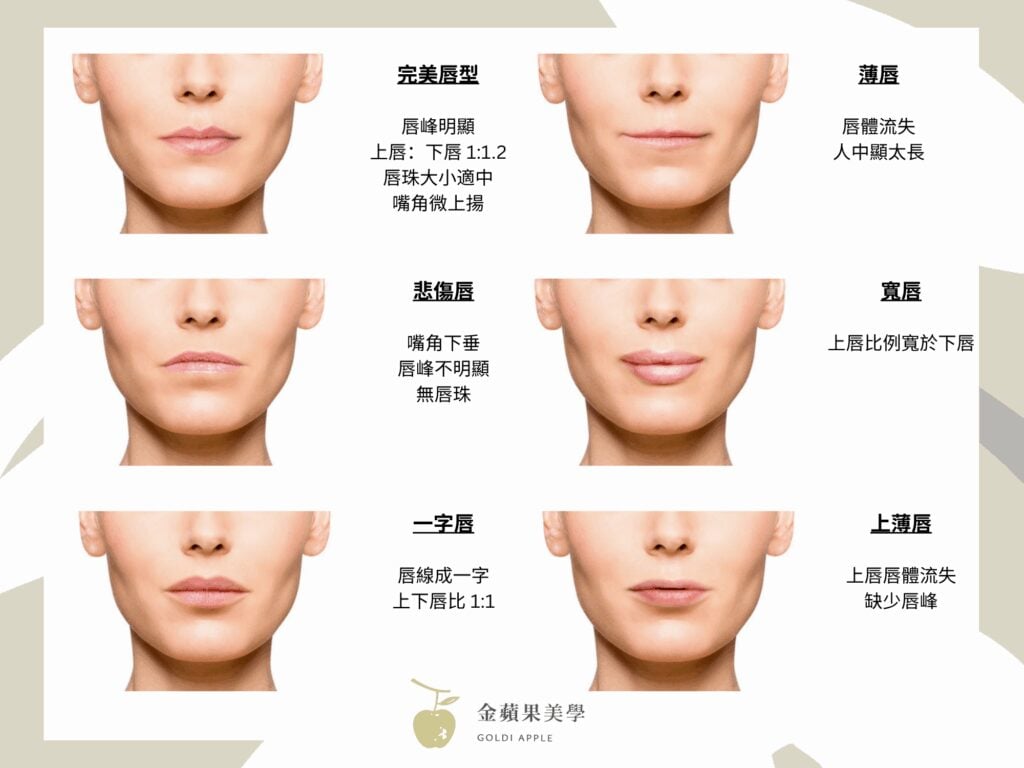 豐唇玻尿酸