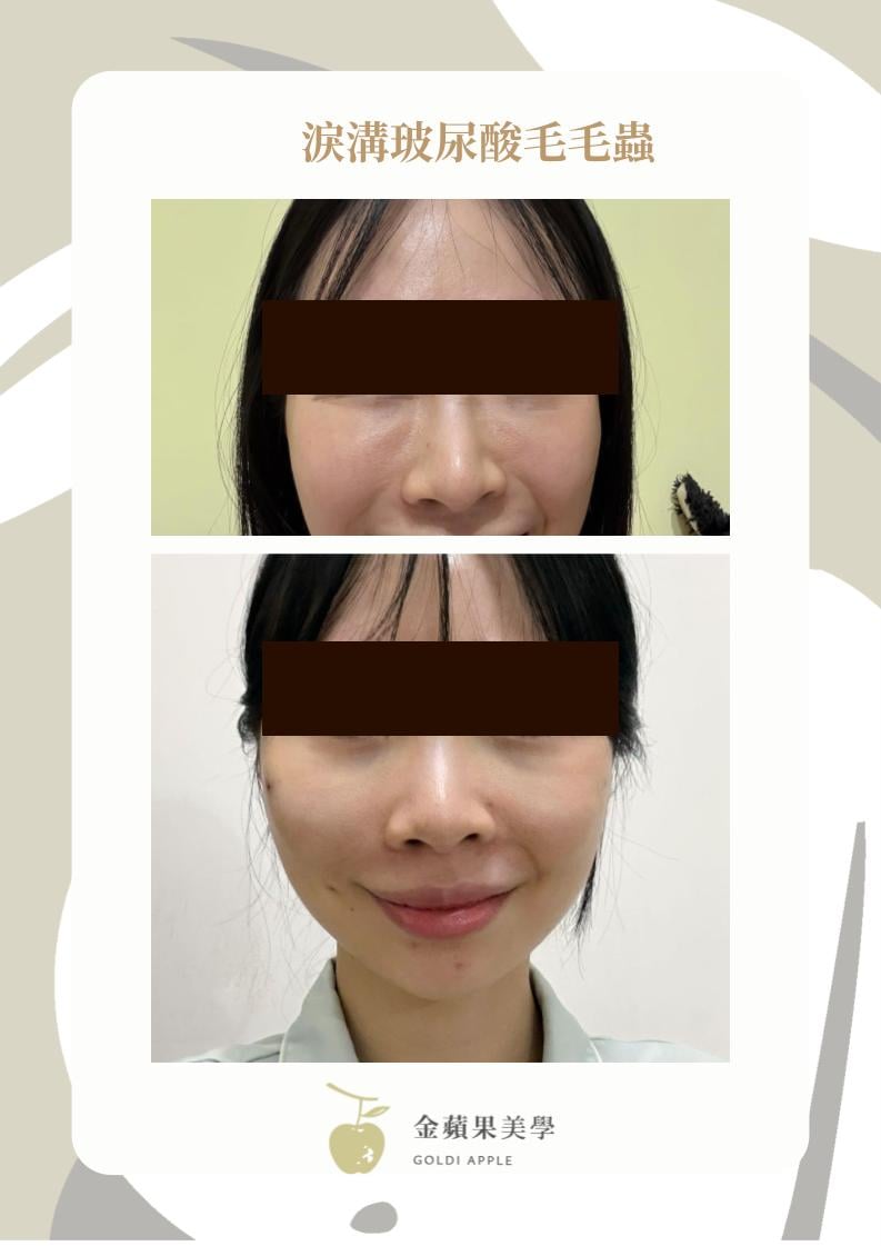薇貝拉淚溝打太淺的後果：淚溝毛毛蟲與眼下凸起