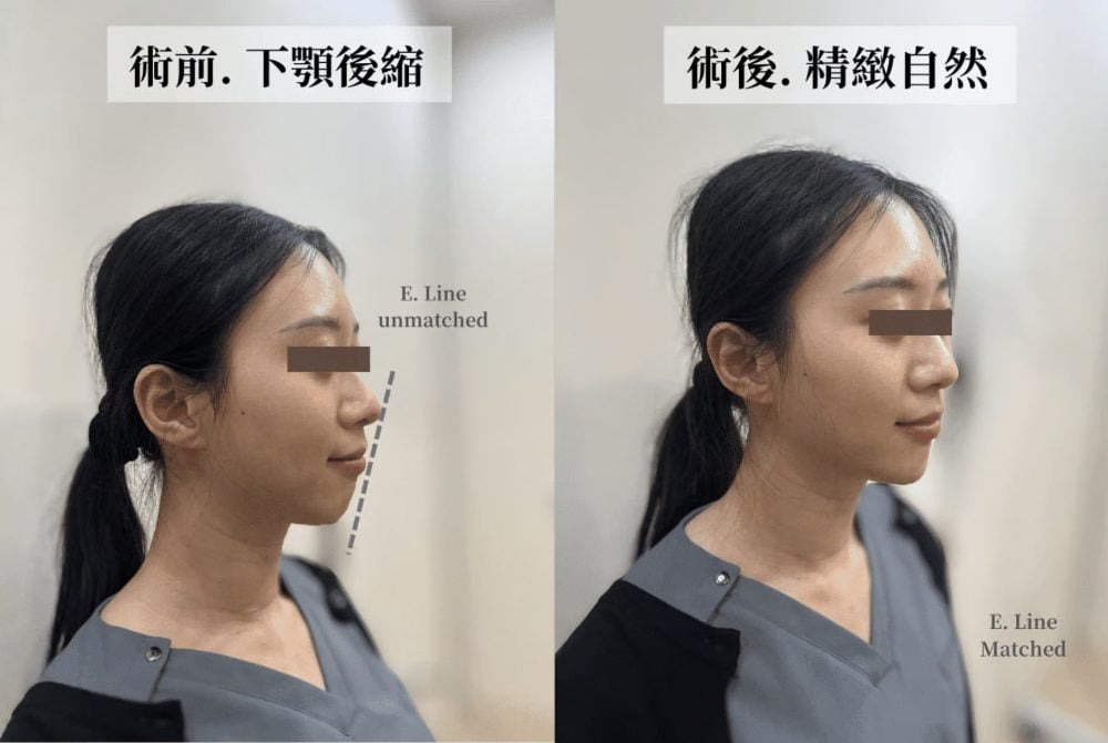 金蘋果美學診所案例 2：打造美觀線（E-Line）