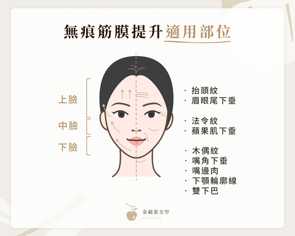 無痕筋膜拉提適用部位：上臉、中臉、下臉