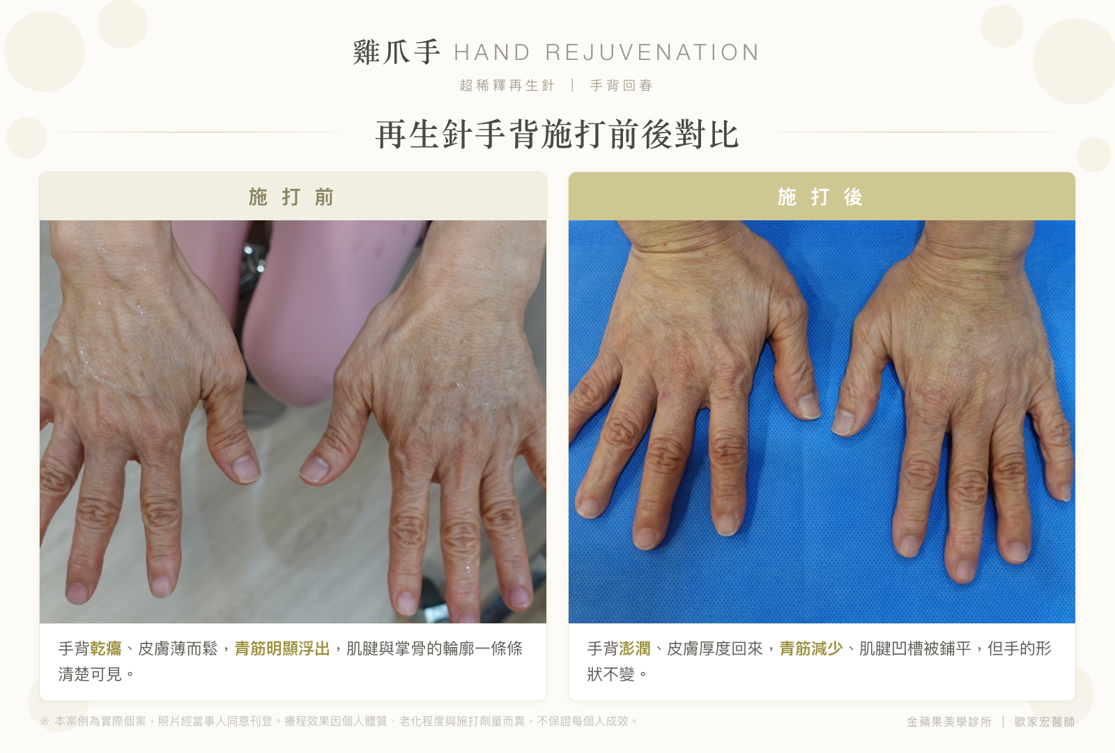 雞爪手再生針手背施打前後對比：施打前手背乾癟、青筋明顯浮出；施打後手背澎潤、青筋減少