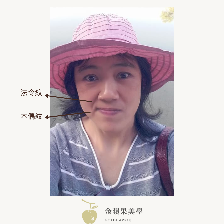 法令紋木偶紋區別