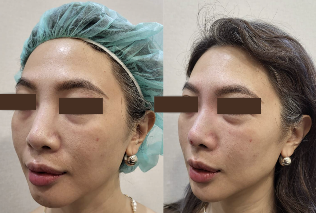 兩張女性斜側臉對照照，搭配說明玻尿酸隆鼻後山根變寬怎麼辦