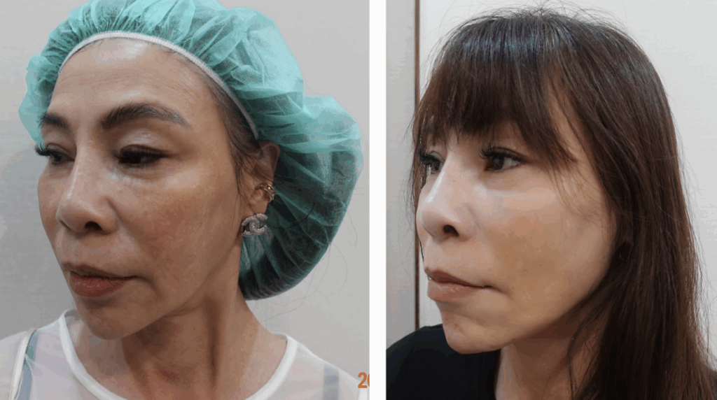 鬆垂型嘴邊肉客人案例對比照，嘴角旁可見木偶紋與嘴邊肉