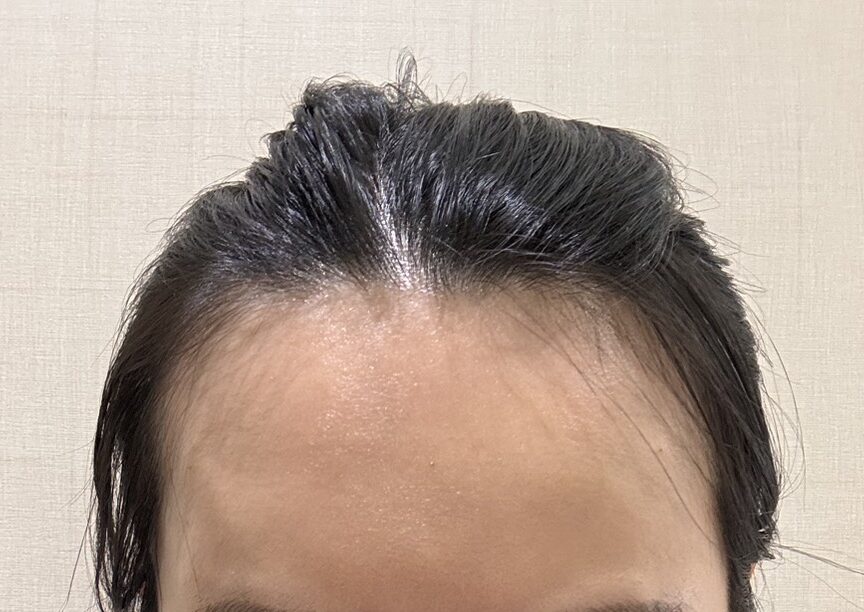 額頭凹凸不平