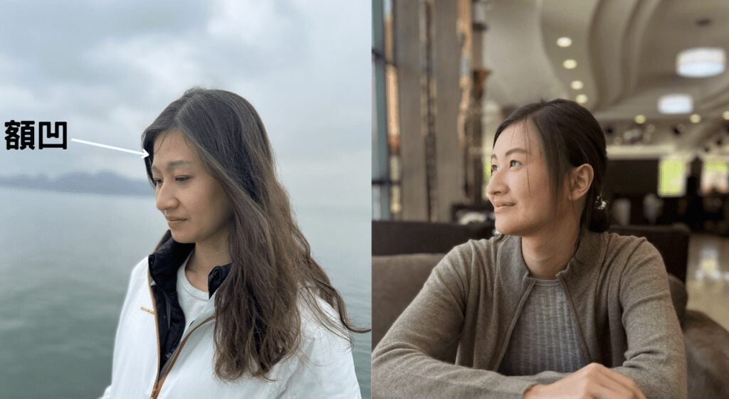 額凹標示對比照：左為額頭凹陷，右為V50玻尿酸豐額約九個月後