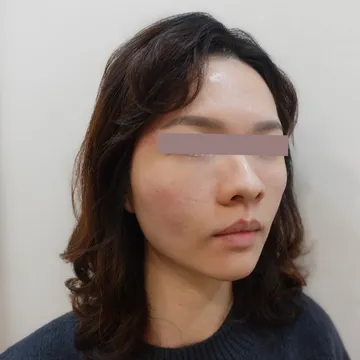 降解後重新施打喬雅登玻尿酸淚溝的女性斜側臉照，外觀自然