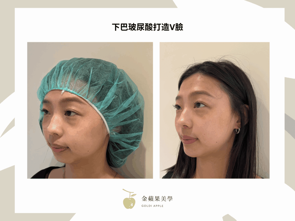 下巴玻尿酸維持多久