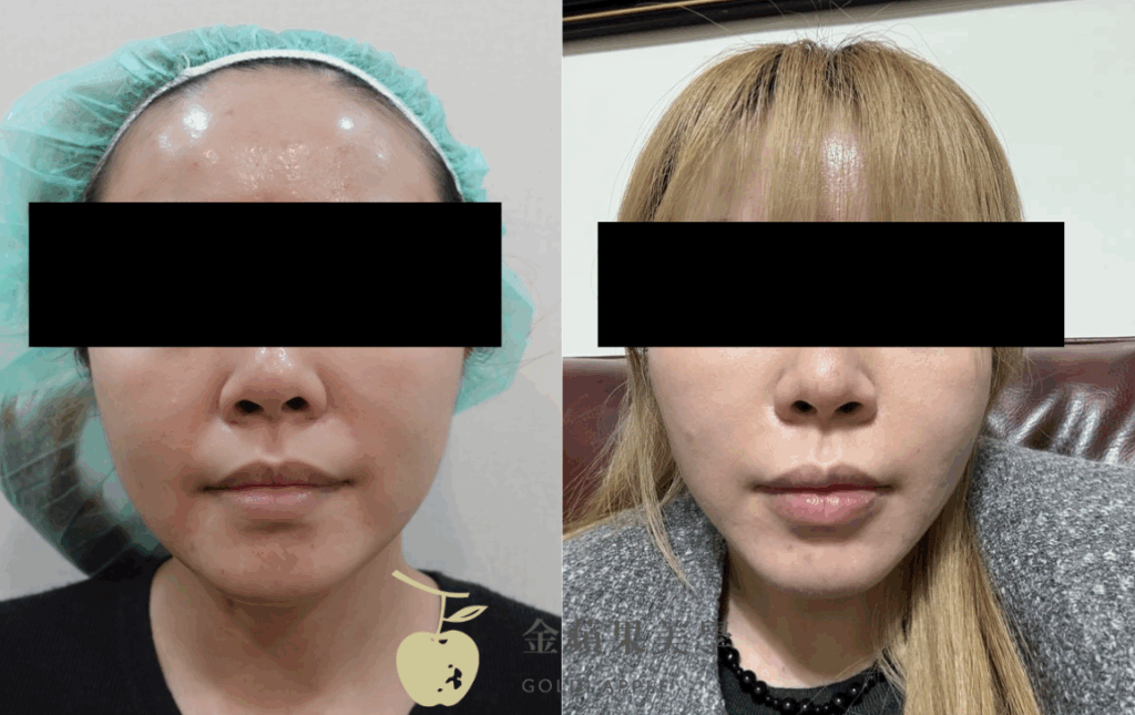 法令紋醫美