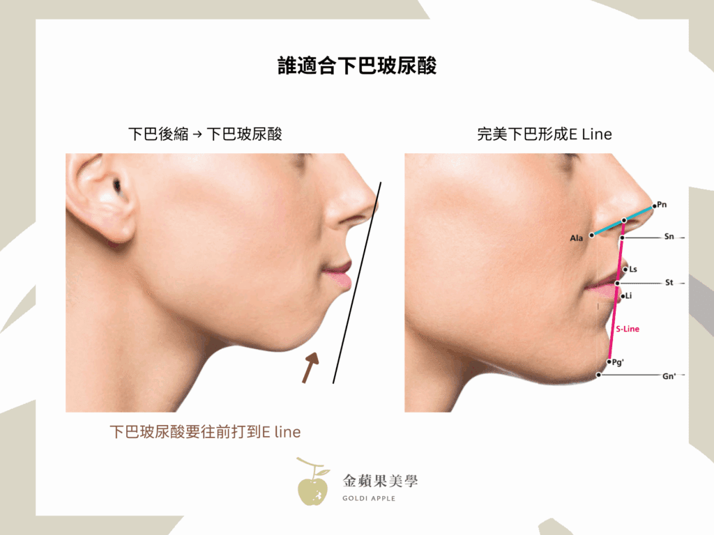 下巴後縮