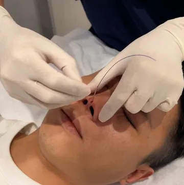 醫師於鼻小柱置入L型埋線的埋線鼻雕操作照