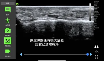 超音波影像標註「厚度降解後有很大落差，證實已清除乾淨」
