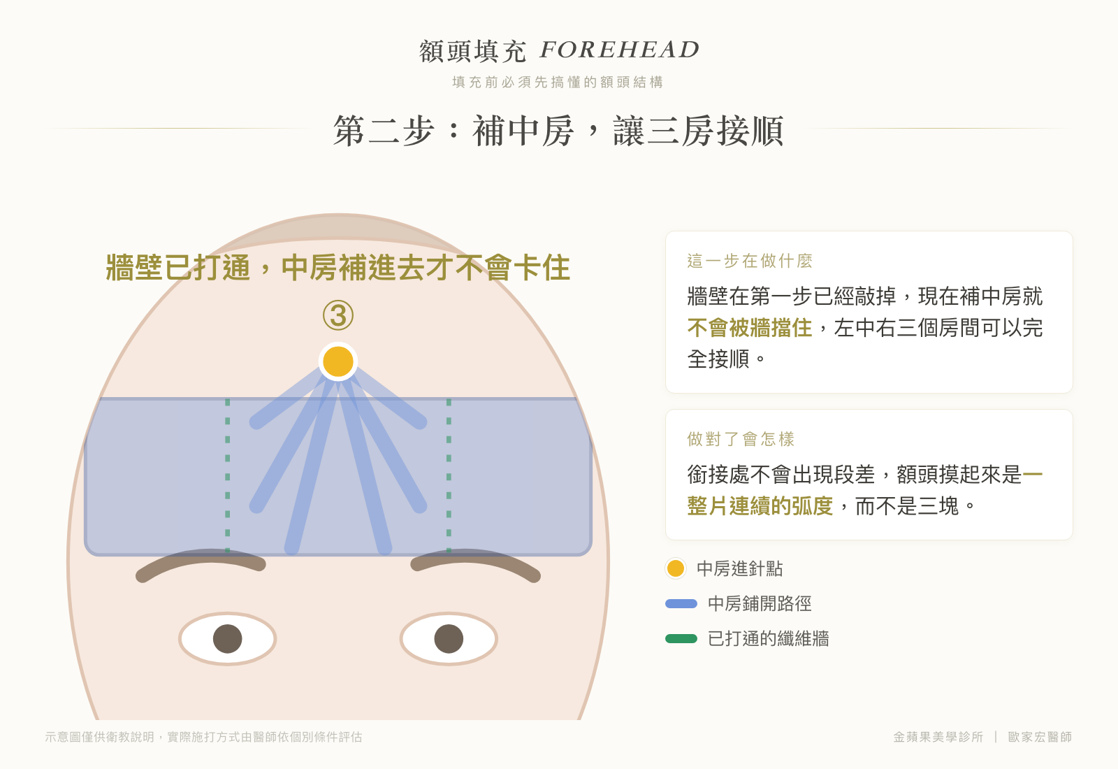 額頭填充第二步示意圖：牆壁打通後補中房，讓左中右三個房間銜接順暢、不出現段差