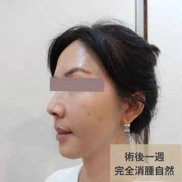 埋線術後一週側臉照，標註「完全消腫自然」