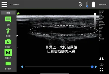 超音波影像標註「鼻骨上一大陀玻尿酸，已經變成娜美人鼻」