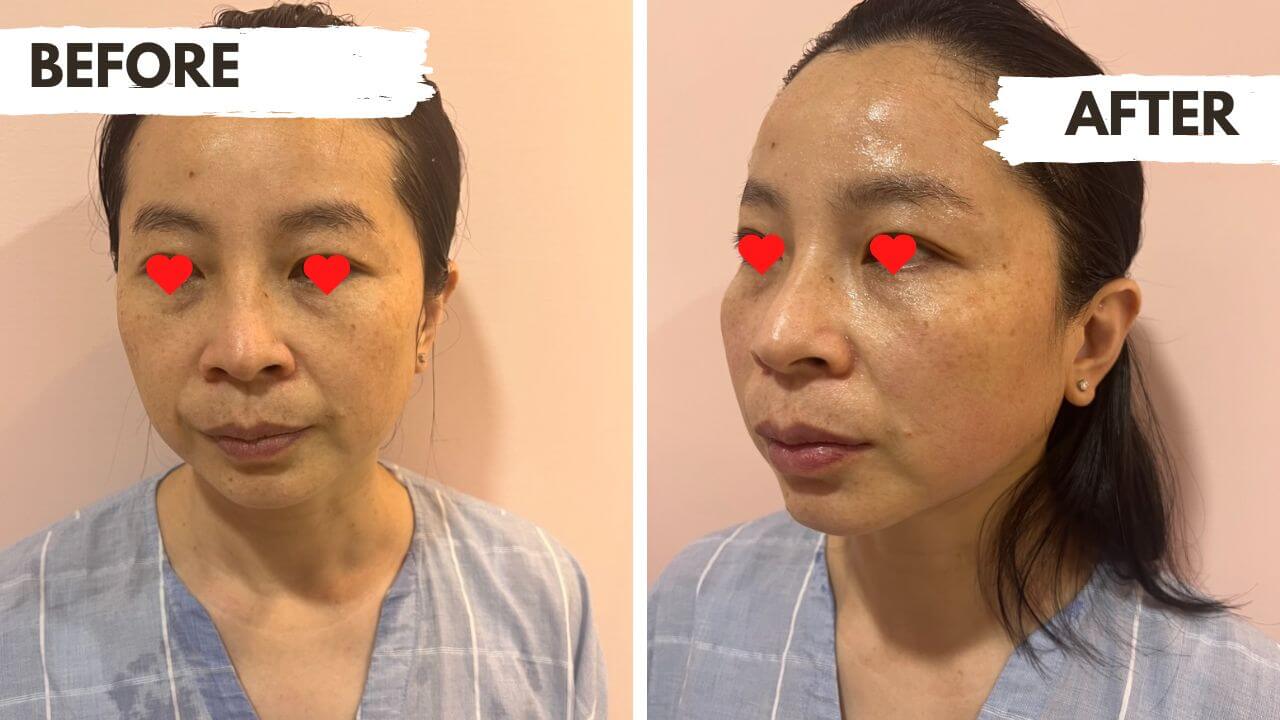 音波拉提前後對照：標示BEFORE與AFTER的女性臉部照片