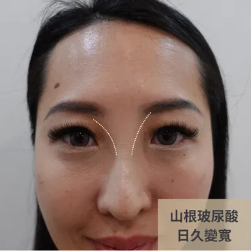 女性正面照標註「山根玻尿酸日久變寬」，虛線標示鼻樑兩側變寬範圍