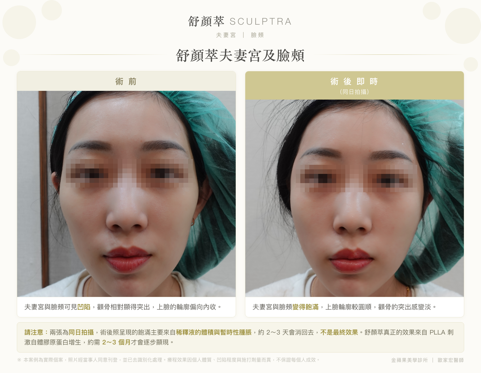 舒顏萃夫妻宮及臉頰術前與術後即時對比：術前夫妻宮與臉頰凹陷，術後即時變得飽滿（同日拍攝，飽滿主要來自稀釋液）