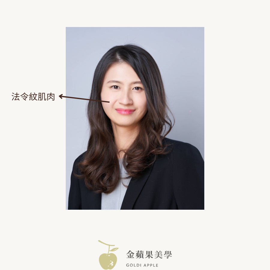 肌肉型法令紋示意圖：箭頭標示鼻翼旁的法令紋肌肉位置
