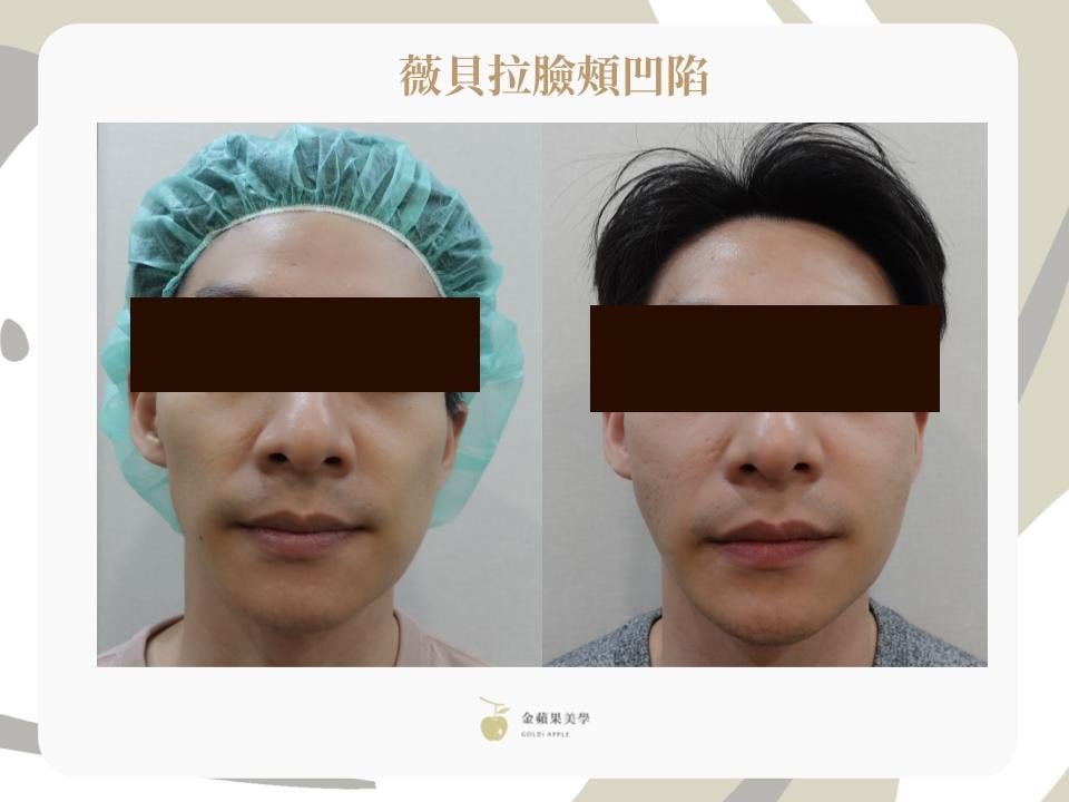 薇貝拉臉頰凹陷治療案例：男性施打三個月後正面左右對照