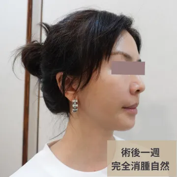 埋線術後一週另一角度側臉照，標註「完全消腫自然」