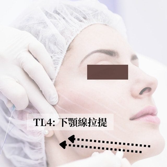 TL4下顎線拉提示意圖：箭頭沿下顎線標示埋線拉提方向