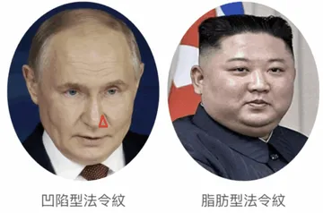法令紋類型示意：左為凹陷型法令紋，右為脂肪型法令紋