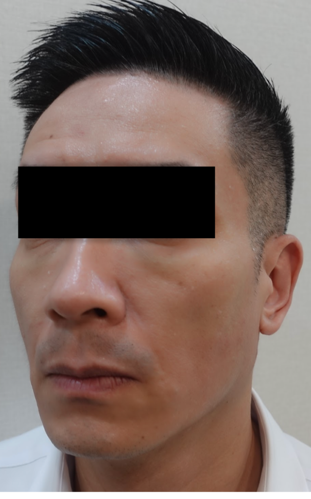 淚溝廷德爾效應案例照：男性眼下可見條狀凸起與青藍色光影