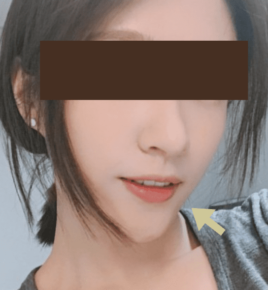 女性側臉照，箭頭標示下巴玻尿酸與下顎線銜接不順顯得太尖