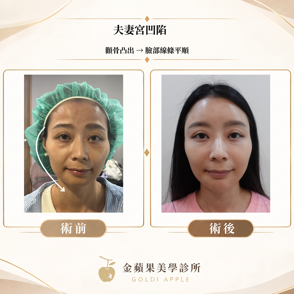 夫妻宮凹陷