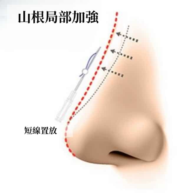 埋線隆鼻
