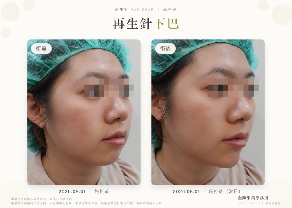 再生針（晶亮瓷）下巴女性案例：施打當日術前術後 45 度側臉對照，眼部已去識別化