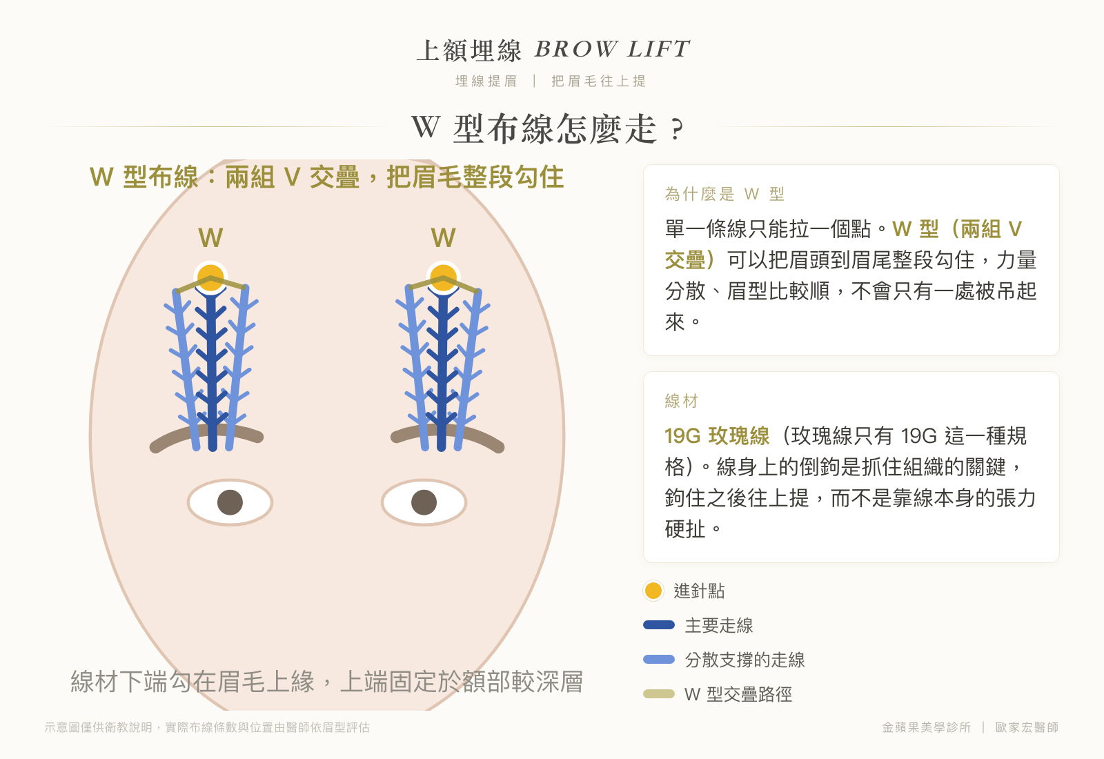 上額埋線 W 型布線示意圖：兩組 V 交疊，19G 玫瑰線倒鉤勾住眉頭到眉尾整段往上提