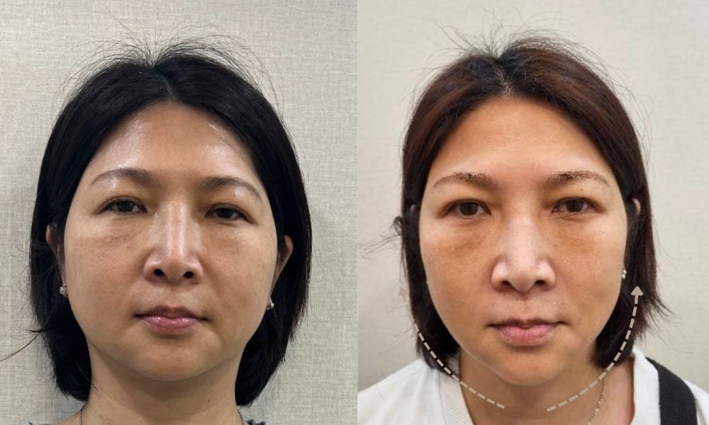 金蘋果美學診所｜消除嘴邊肉案例二