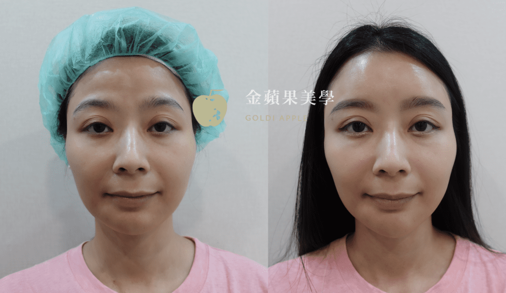 洢蓮絲豐額治療前後對比照：治療後額頭飽滿平滑