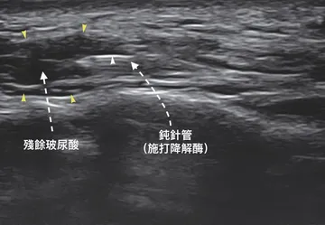 超音波影像：鈍針管於淚溝施打降解酶，並標示殘餘玻尿酸位置