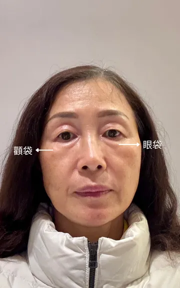 中年女性正面照，標示眼袋與顴袋的位置