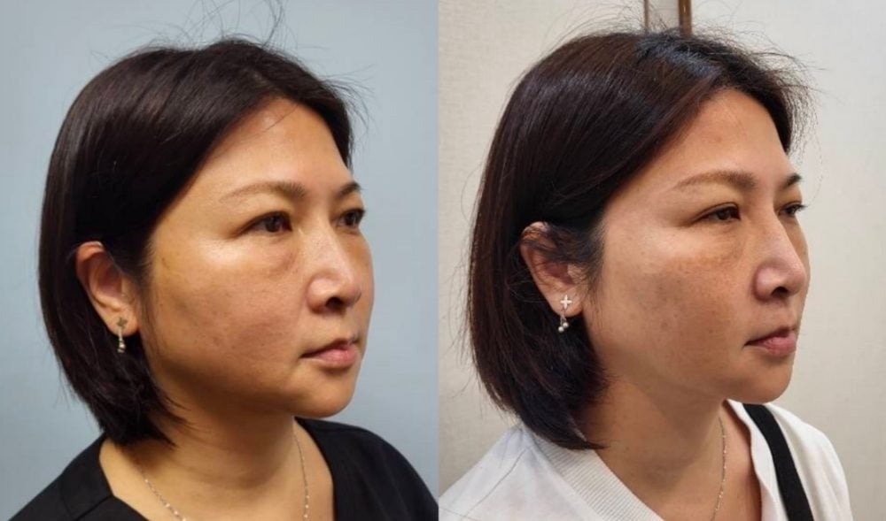 金蘋果美學診所｜消除嘴邊肉案例二